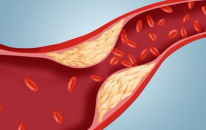 Cholesterol cao – Triệu chứng và cách nhận biết